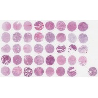 BC000111b Multiple organ cancer tissue array, including TNM, clinical ...