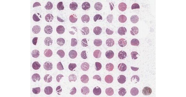 BC09022 Endometrial carcinoma tissue array with cancer adjacent tissue ...