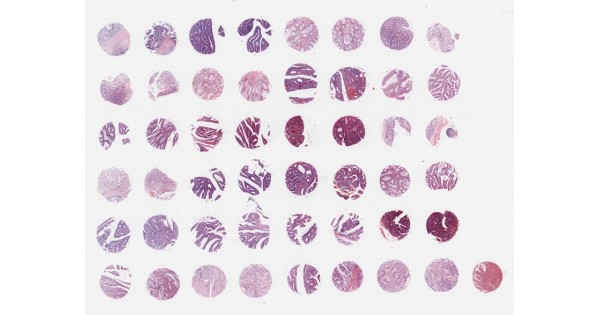 BIC05011 Colonic intraepithelial neoplasia tissue array, 24 cases/ 48 ...