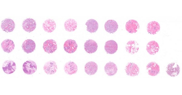 BR251-L62 Breast invasive carcinoma of no special type with matched ...