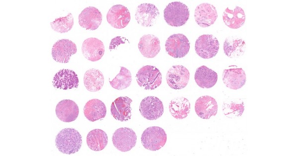 BR302 Breast cancer single pathological type tissue array, including ...