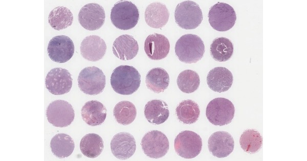 BS20011c Lymphoma tissue array, 30 cases/ 30 cores(core size 2.0mm ...