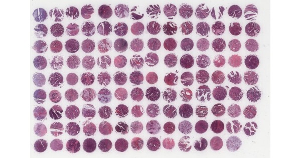 CO1251 Colon adenocarcinoma tissue array, including ulcer, uplift and ...