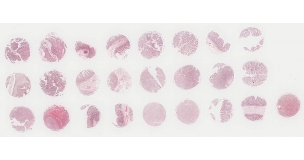 CO241b Colon adenocarcinom with matched NAT tissue array, including TNM ...