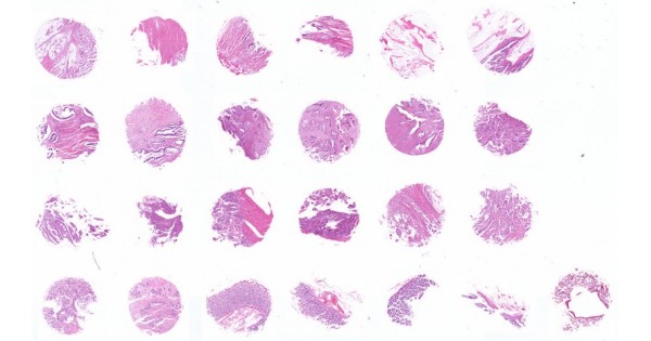 CO242c Colon carcinoma tissue array with (NAT) normal adjacent tissue ...