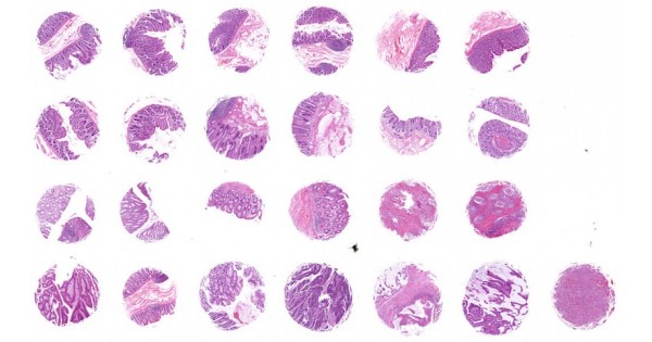 CO245b Colon multi-disease type tissue array, with normal colon tissue ...