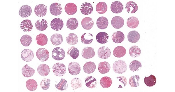 CO484b Colon cancer tissue array with adjacent normal tissues ...