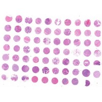 CO702e Colon primary cancer tissue array with metastastic cancer and ...