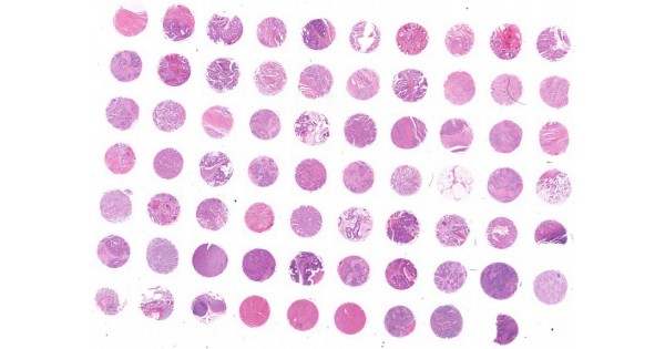 CO702e Colon primary cancer tissue array with metastatic cancer and ...