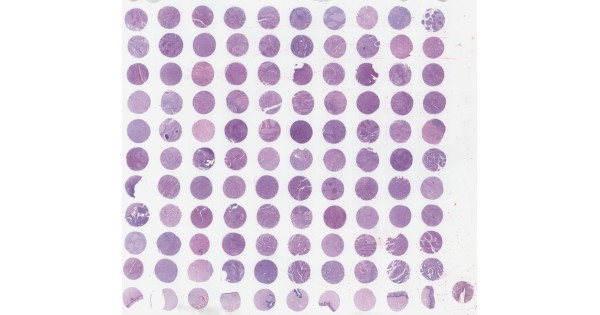 CR1101 Cervical cancer tissue array with adjacent normal cervical ...