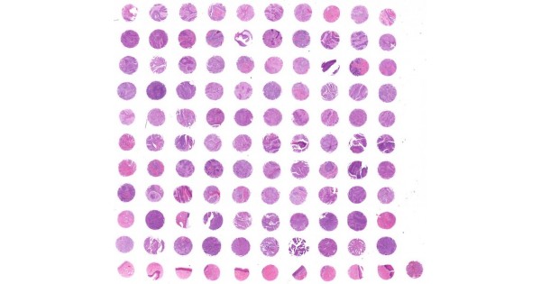 CR1101a Cervical cancer tissue array with normal adjacent cervical ...