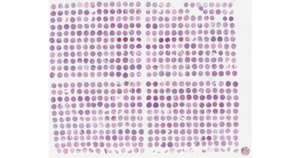 CR6161 High-density uterine cervix cancer array, with normal cervical ...