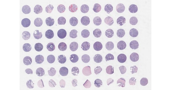 CR701 Cervical carcinoma, adjacent tissue and adjacent normal tissue ...