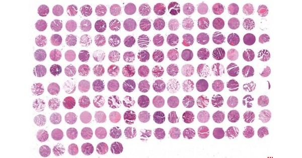 CRM1504 Colon cancer tissue array, 150 cases/150 cores - TissueArray ...