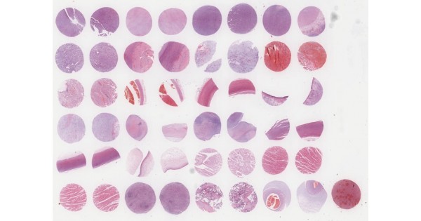 CV481 Cardiovascular disease tissue array, including TNM and clinical ...
