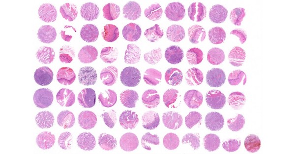 ES702a Multiple esophagus cancer tissue with matched cancer adjacent ...