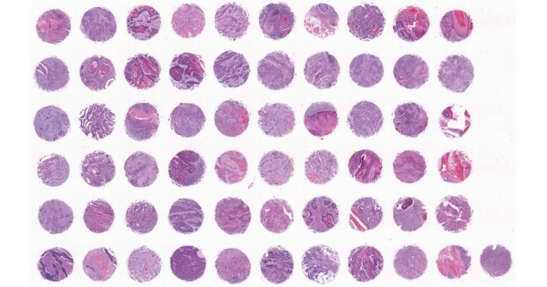 HN601-L52 Head and neck squamous cell carcinoma tissue array,including ...