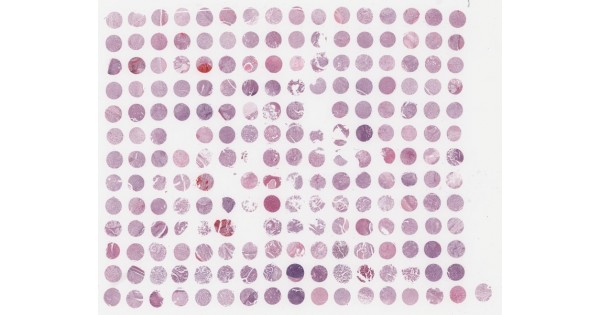 KD20812a Kidney cancer survey tissue array (3 of 3), including TNM and ...