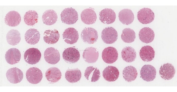 KD321a Kidney cancer tissue array with matched adjacent normal tissue ...