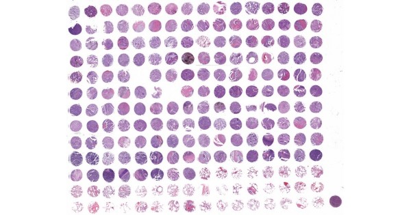 LC2085d High-density lung cancer with lung tissue array, including ...