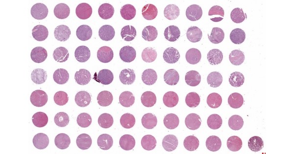 LV701 Liver cancer and liver tissue array, including pathology grade ...