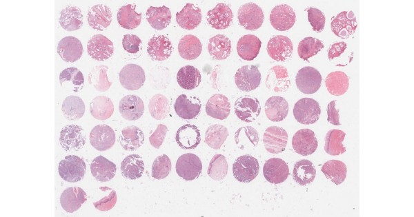 OD-CT-Rp03-002 Human multiple organ tissue array (5 types) tumor (1 ...