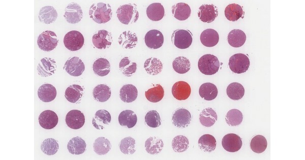 ON481 Oncocytoma tissue array, 24 cases/48 cores - TissueArray.Com ...