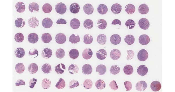 OR601c Oral squamous cell cancer tissue array with adjacent normal ...