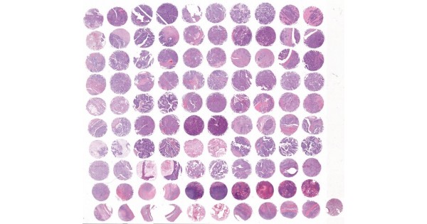 OV1004a Ovary cancer with ovary tissue array, including high grade ...