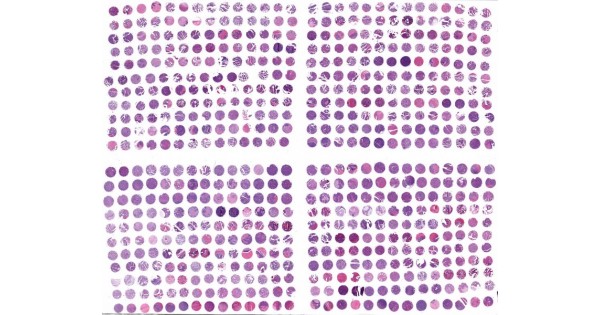 OV6161a High-density ovarian cancer array, including TNM/Stage (AJCC ...