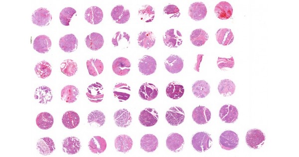PA486 Pancreas intraepithelial neoplasia (PanIN), pancreatitis and ...