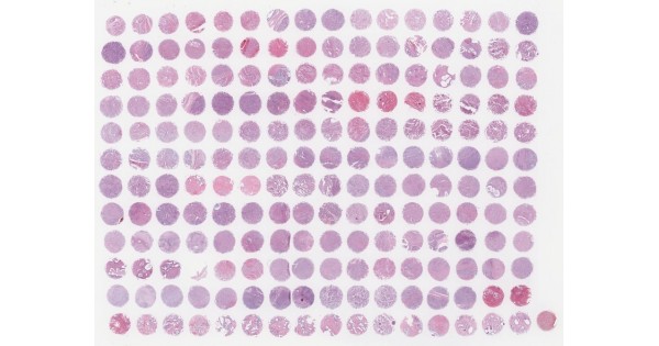 PR208a High-density prostate cancer tissue array, including TNM ...