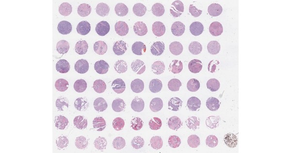 PR721 Prostate cancer tissue array with cancer adjacent tissues ...
