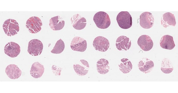 RE241 Rectal cancer test tissue array with unmatched normal adjacent ...