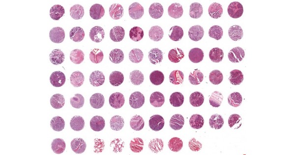 SCLC681Sur Lung small cell carcinoma (SCLC) and normal tissue ...