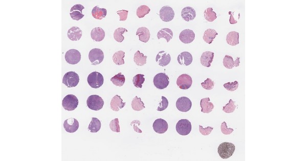 SK481 Skin cancer tissue array with corresponding (unmatched) normal ...