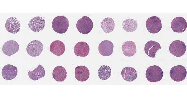 SP241 Spleen cancer tissue array with unmatched normal adjacent tissues ...