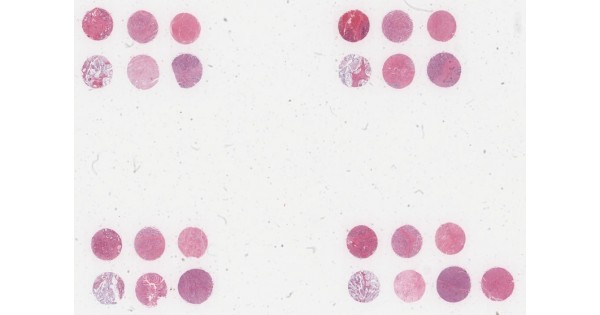 T014a Stomach cancer test tissue array, including pathology grade, TNM ...