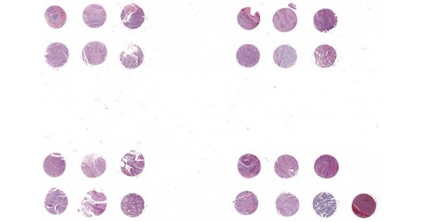 T104a Cervix cancer tissue array, including squamous cell carcinoma ...