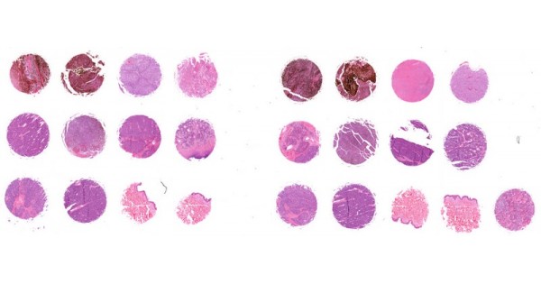 T382-L29 Malignant melanoma test tissue array with skin tissue ...