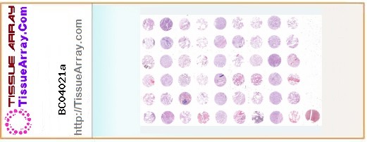 TissueArray.Com Tissue Array BC04021a