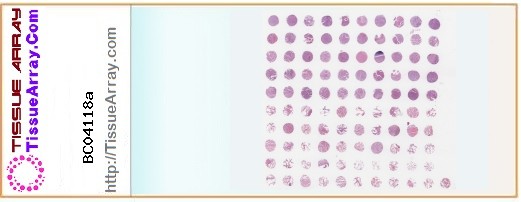 TissueArray.Com Tissue Array BC04118a