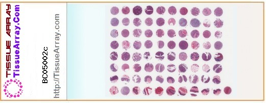 TissueArray.Com Tissue Array BC05002c