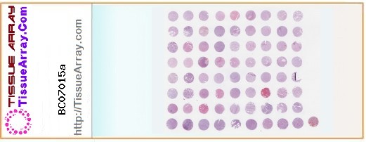 TissueArray.Com Tissue Array BC07015a