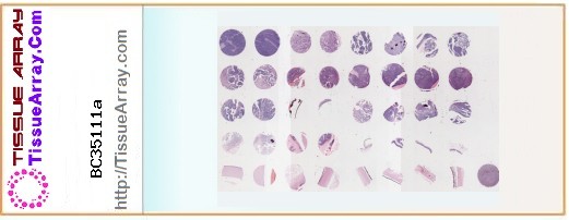 TissueArray.Com Tissue Array BC35111a