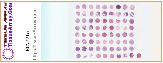 TissueArray.Com Tissue Array BCN721a
