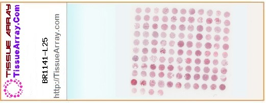 TissueArray.Com Tissue Array BR1141-L25