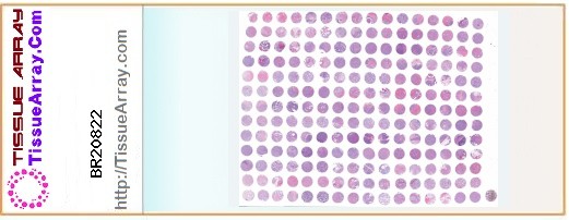 TissueArray.Com Tissue Array BR20822