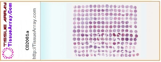 TissueArray.Com Tissue Array CO2081a