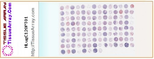 TissueArray.Com Tissue Array HLugC120PT01